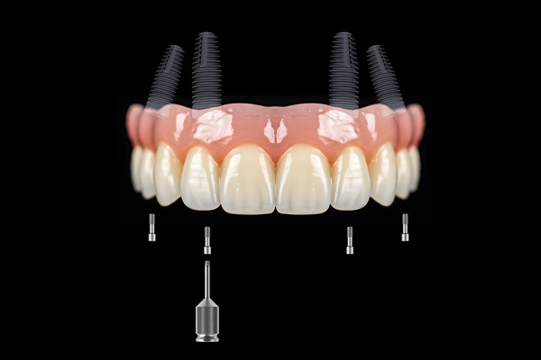 Replacing Upper Or Lower Set Of Teeth With All On