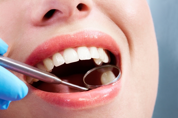 Signs You May Need A Dental Filling